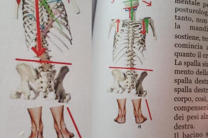 Scoliosi (Idiopatica) o Disequilibrio Meccanico Abituale del corpo umano?