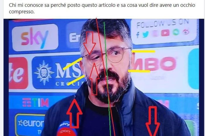 Il calciatore Gattuso e l’occhio destro compresso meccanicamente