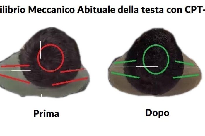 Con il CPT-OG OcclusioneGravità l’individuo si raddrizza sul BARICENTRO, sui 3 assi spaziali, CONTEMPORANEAMENTE!