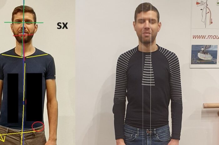 L’effetto cavatappi OG: irrisolvibile da qualsiasi trattamento esistente